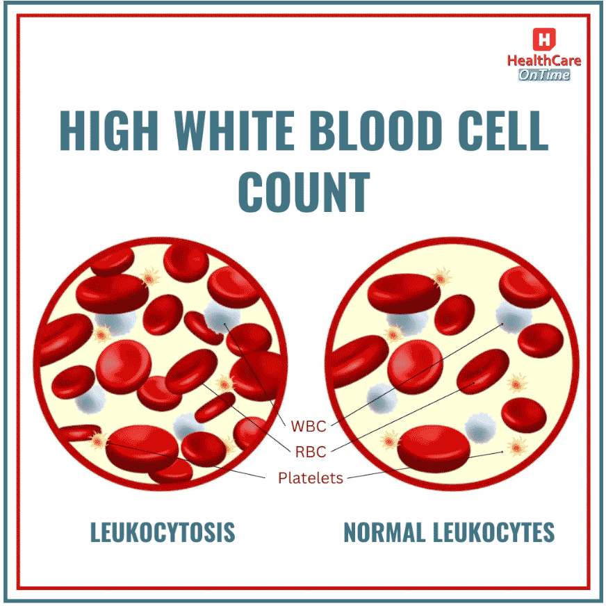 Leukocytosis (High WBC Count)
