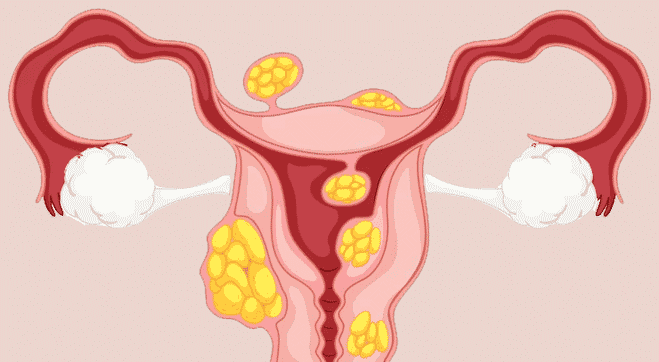Uterine Tuberculosis